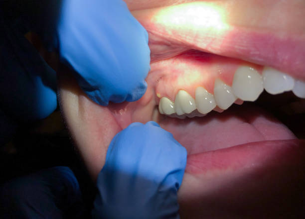 Best Emergency Denture Repair in Wenatchee, WA